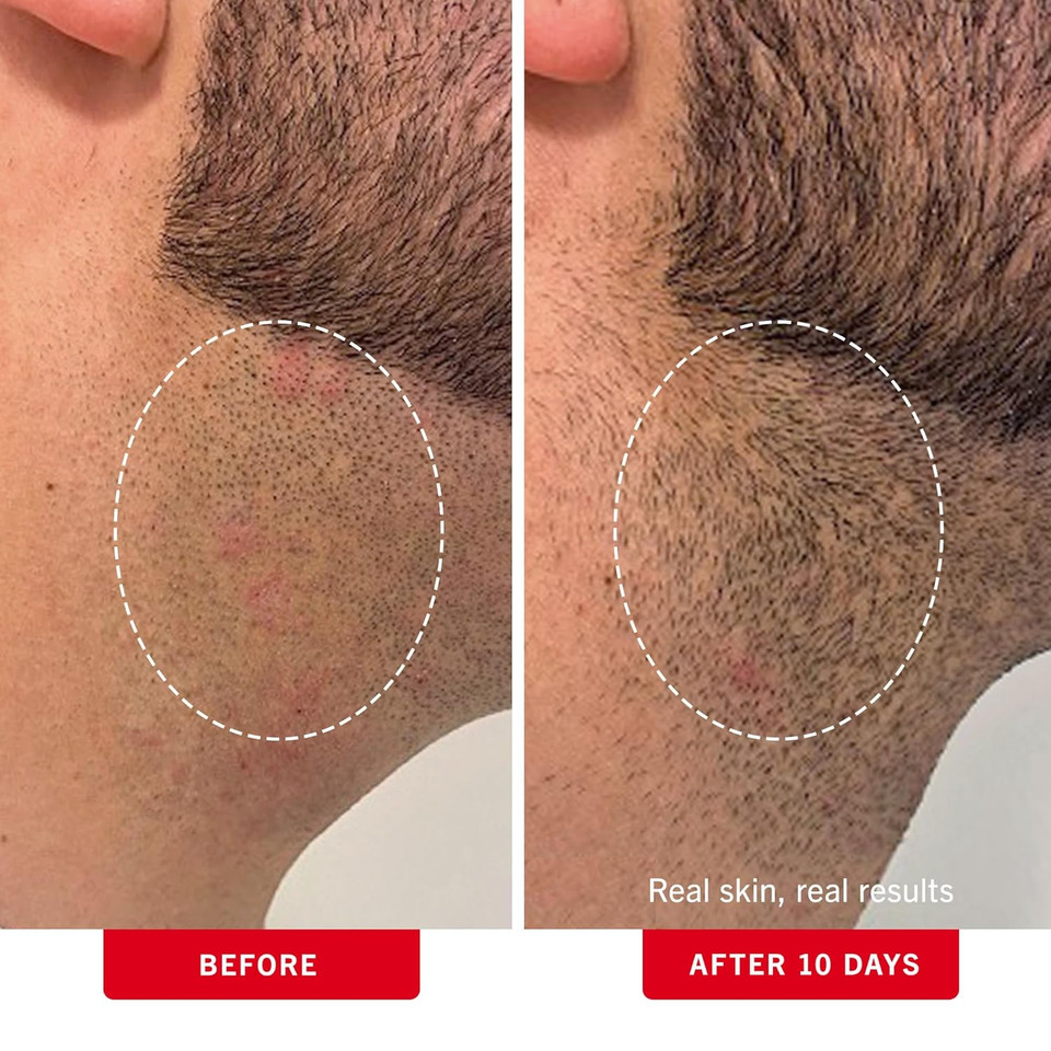 Ingrown Hair Treatment Pads - Image 4