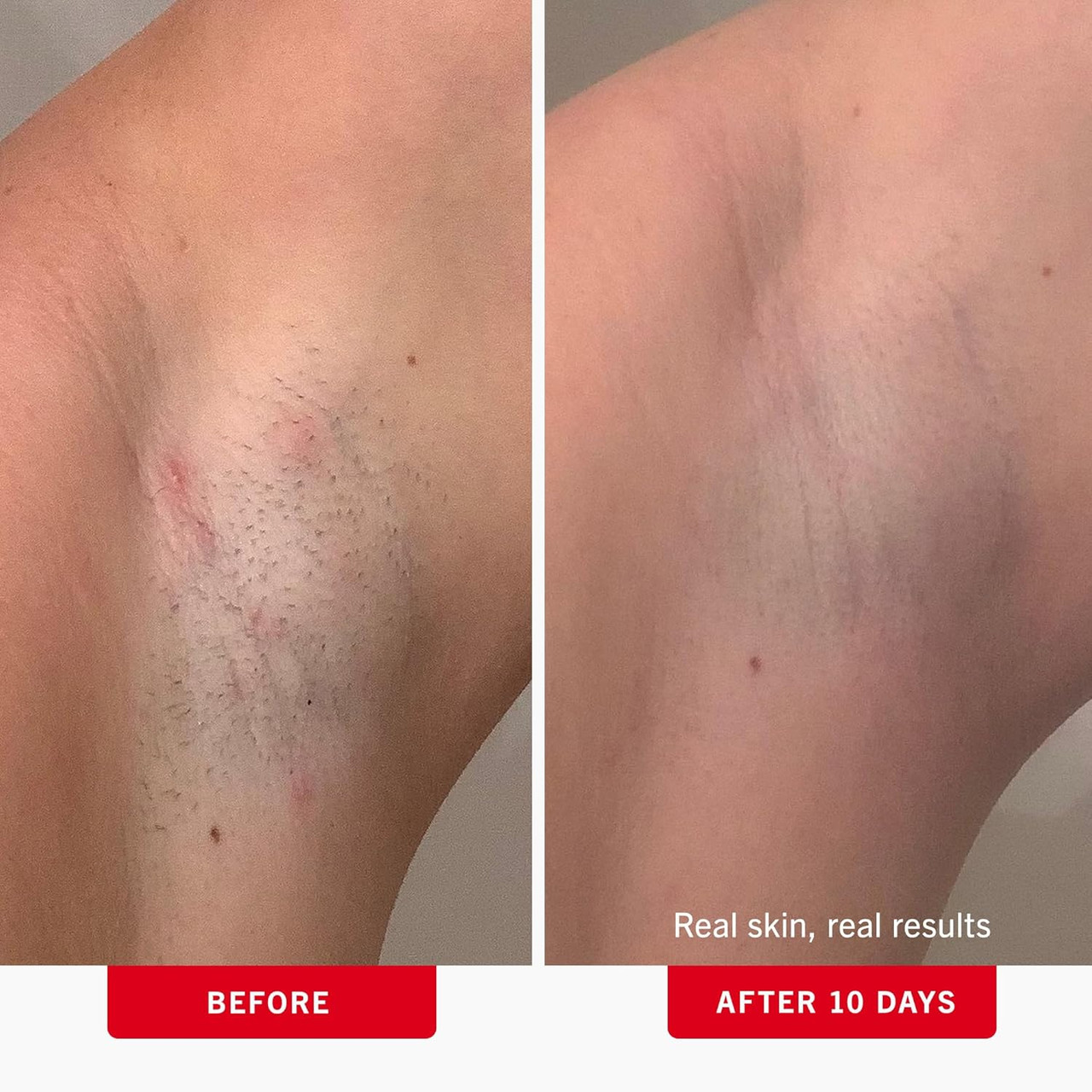 Ingrown Hair Treatment Pads - Image 3